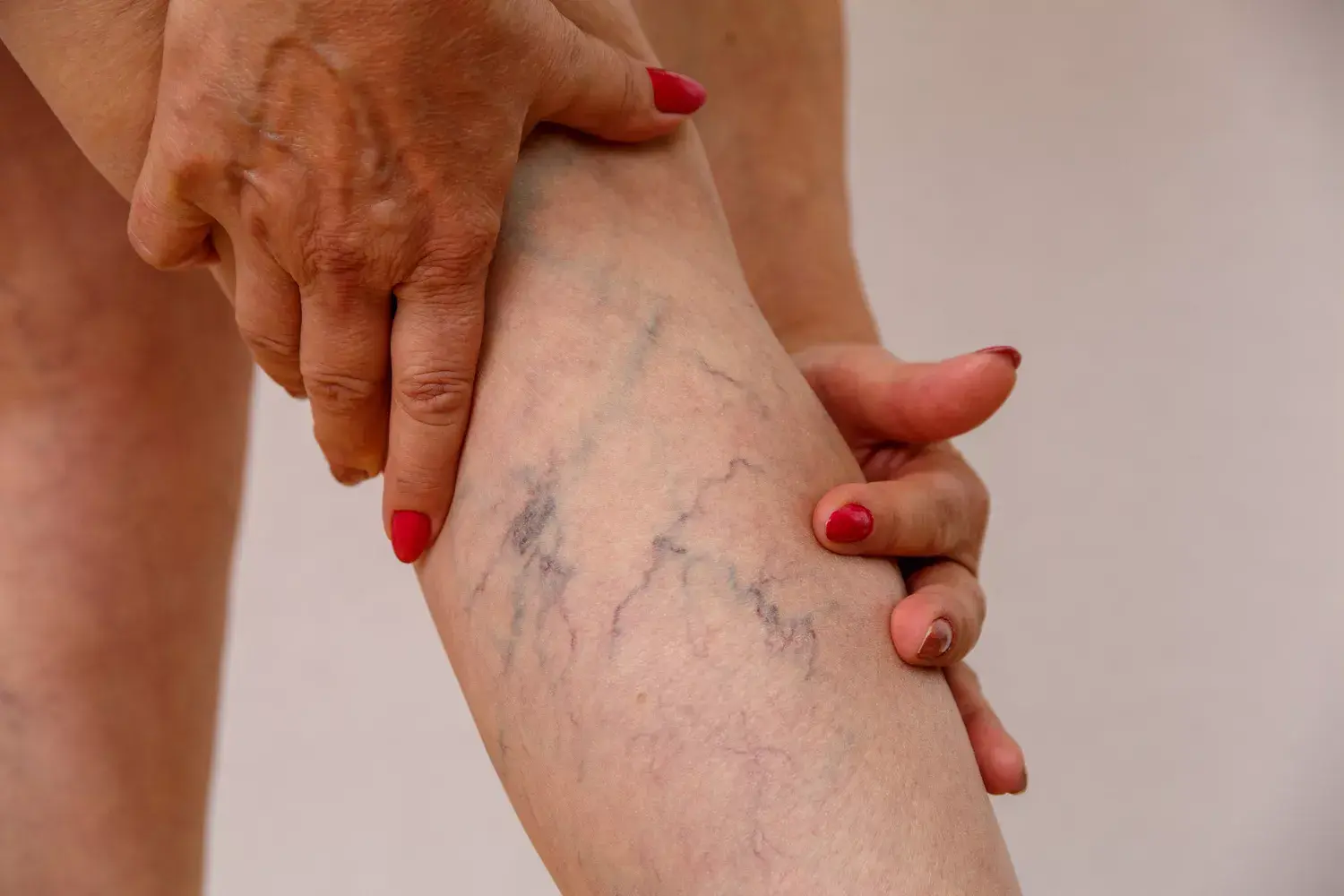 From Blue to Better: Naturopathic Secrets for Varicose Veins Relief